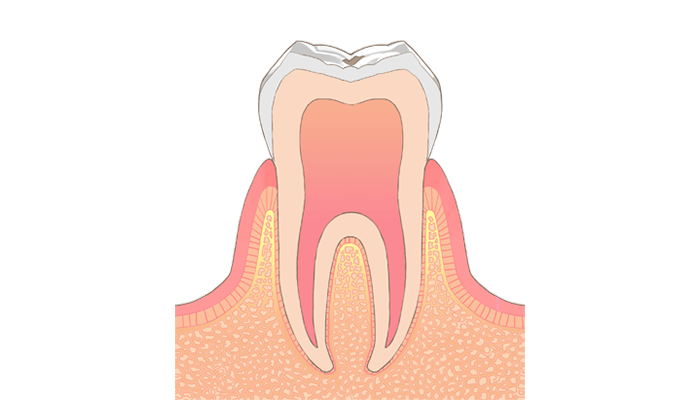C0:ごく初期のむし歯