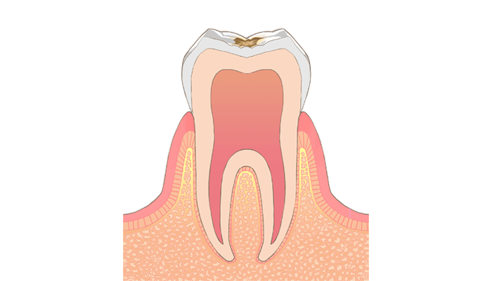 C1:エナメル質のむし歯