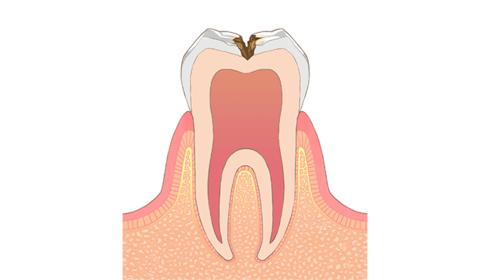 C2:象牙質のむし歯