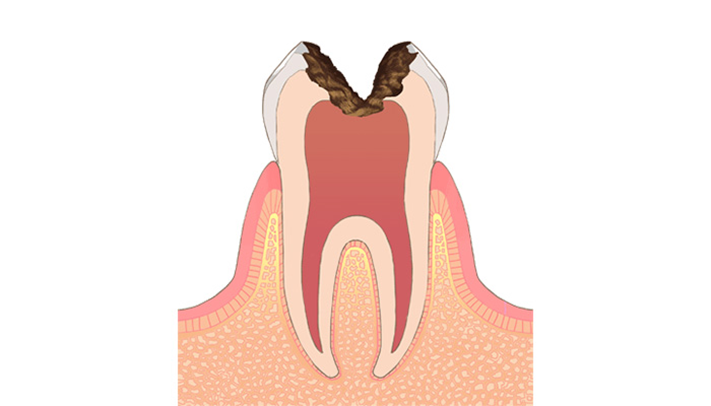 C3:神経に達したむし歯