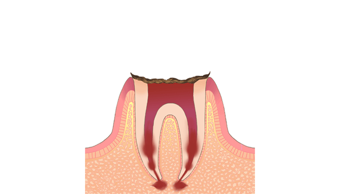 C4:歯根に達したむし歯