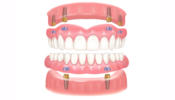 入れ歯（義歯）の種類・特徴