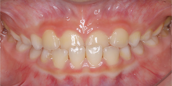小児矯正の症例①治療前