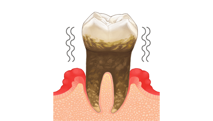 重度歯周炎